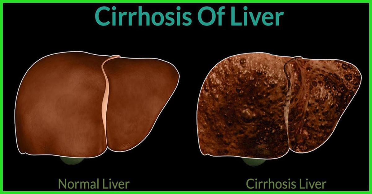 Cirrhosis Of The Liver Symptoms Of Stages, Causes Cirrhosis Of The Liver Symptoms Of Stages, Causes
