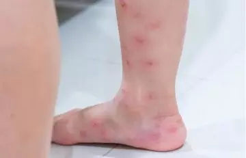 Fire ant bite