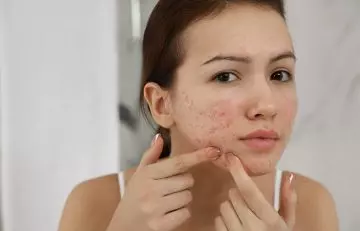 Woman dealing with acne breakouts 