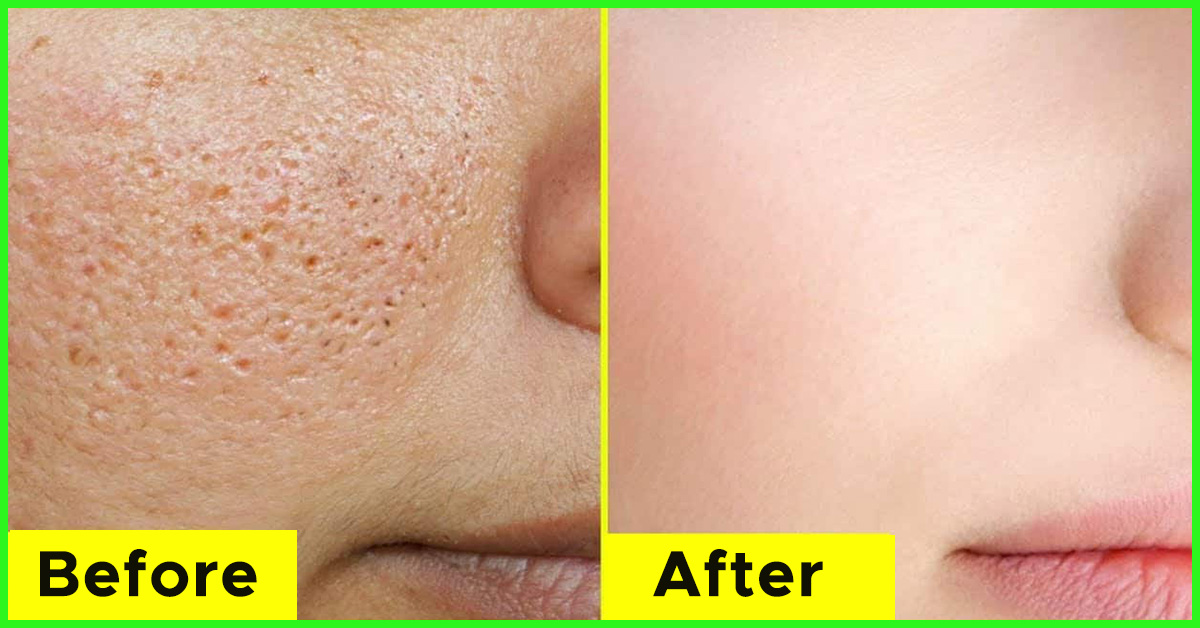 20 Home Remedies To Get Rid Of Open Pores On Skin