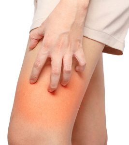 How To Treat And Prevent A Chafing Rash Naturally