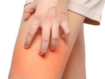 How To Get Rid Of Chafing Rash Overnight + Prevention Tips