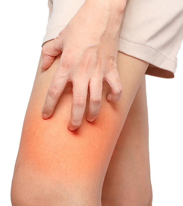 Chafing: Treatment, Prevention, and Causes