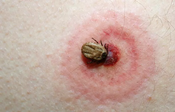 Tick bite