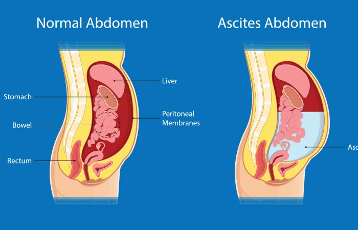 Pictorial representation of a person with ascites