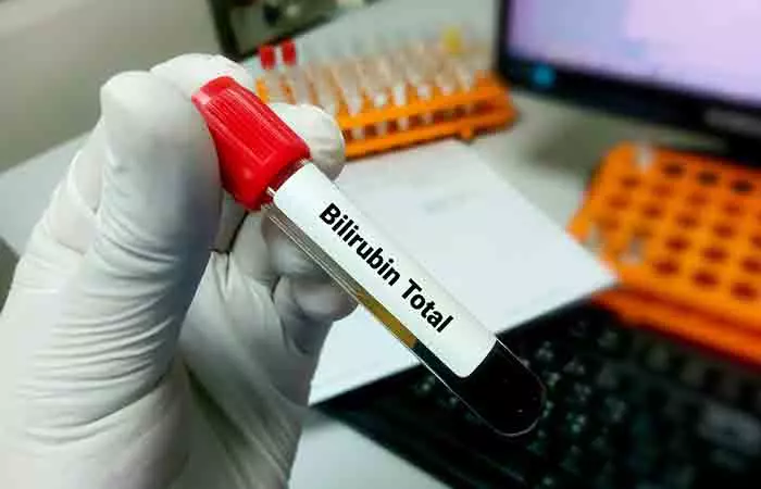 Lab worker checks bilirubin levels to determine the level of jaundice