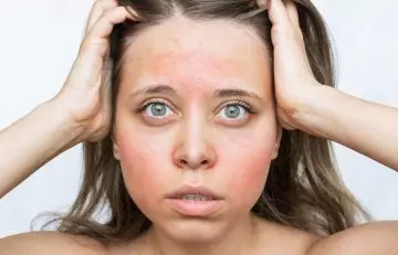 Woman experiencing allergic reaction as a side effect of soy proteins