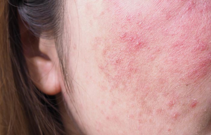 A close-up of dermatitis on the face of a young woman.