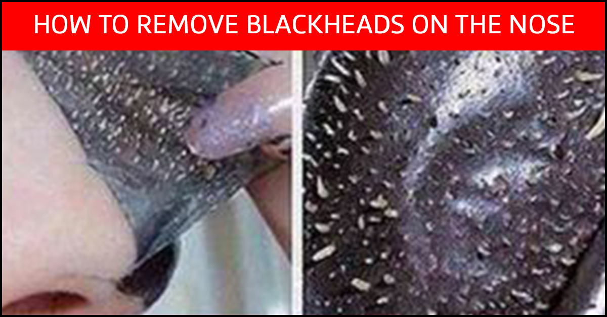 How To Remove Blackheads On Nose at Home Fast