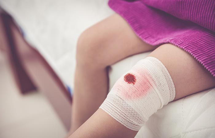 Bleeding knee wound and slow blood clotting 