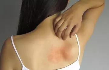 Close up of a young woman scratching her itchy back with allergy rash.