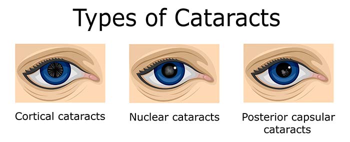 Types Of Cataracts
