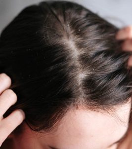 10-Best-Home-Remedies-For-Dry-Scalp-And-Prevention-Tips