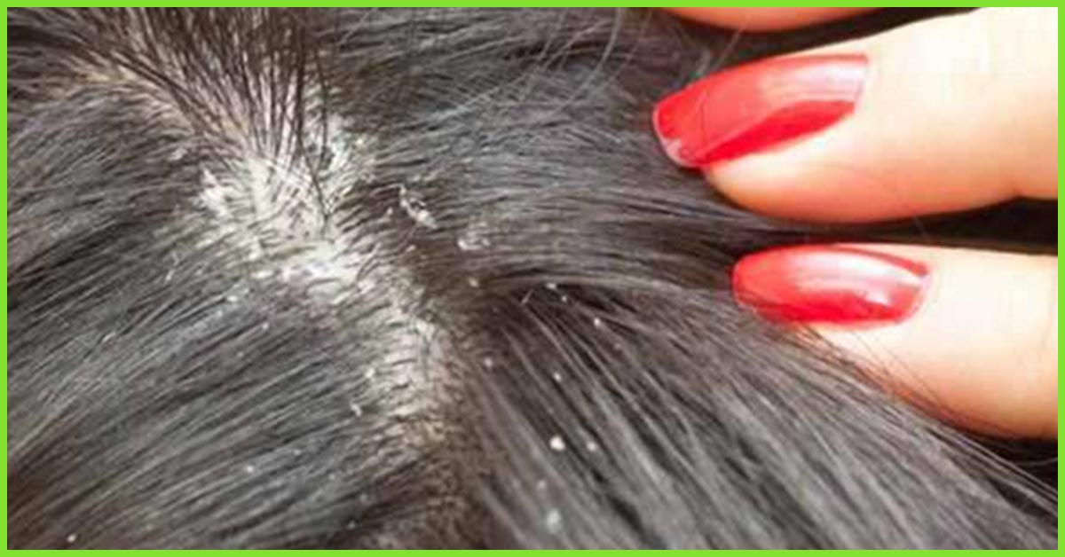 Scalp for and natural itchy home remedies dandruff Natural Home