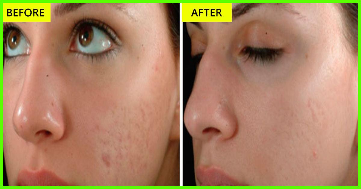 10 Easy Ways To Use Olive Oil To Get Rid Of Acne Scars