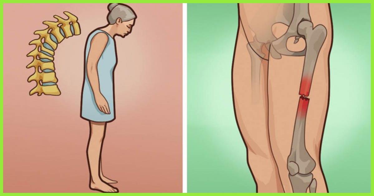 Natural Treatment For Osteoporosis Symptoms, Risk