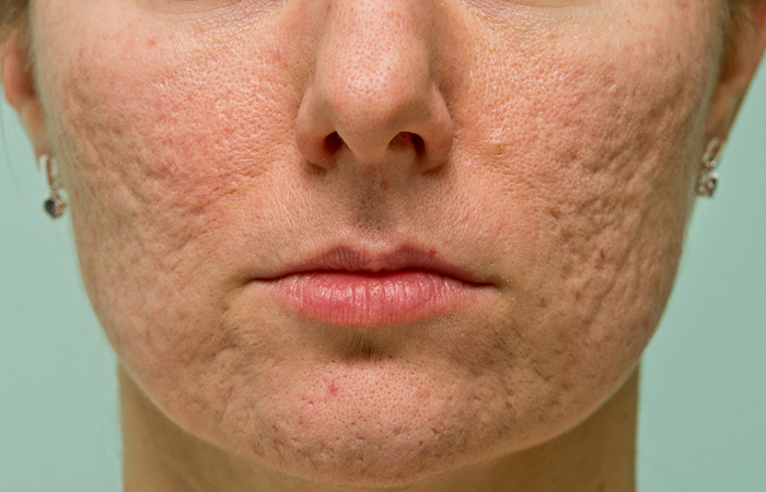 Woman with acne scars may benefit from olive oil