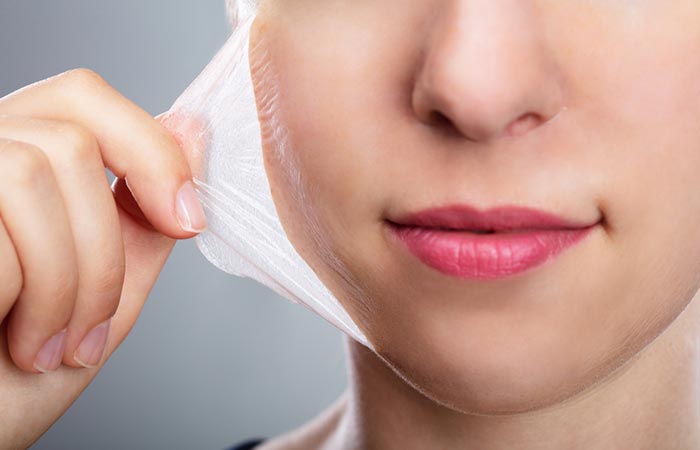 Chemical peels reduce ice pick scars