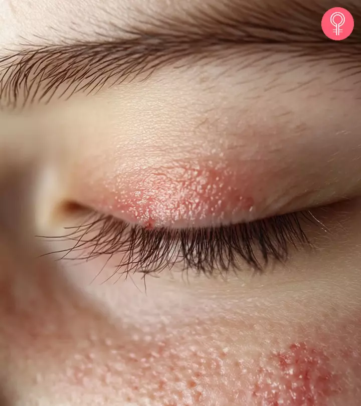 Home Remedies For Eye Rash