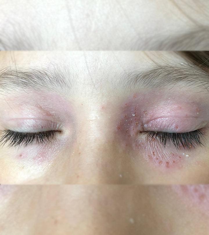 allergic-reaction-to-makeup-around-eyes-saubhaya-makeup