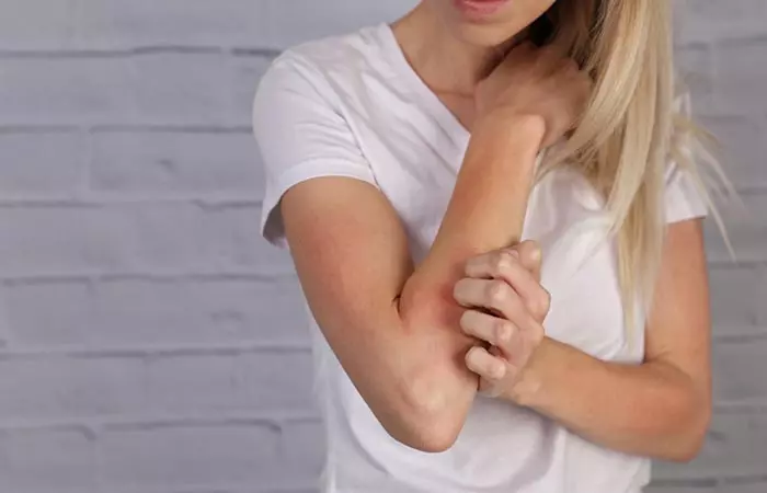 Woman scratching her skin as a side effect of mushroom