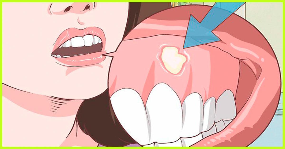 how-to-ease-wisdom-tooth-pain-while-pregnant-pin-on-home-remedies