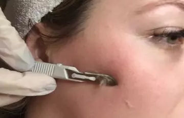 Dermaplaning to remove white facial hair