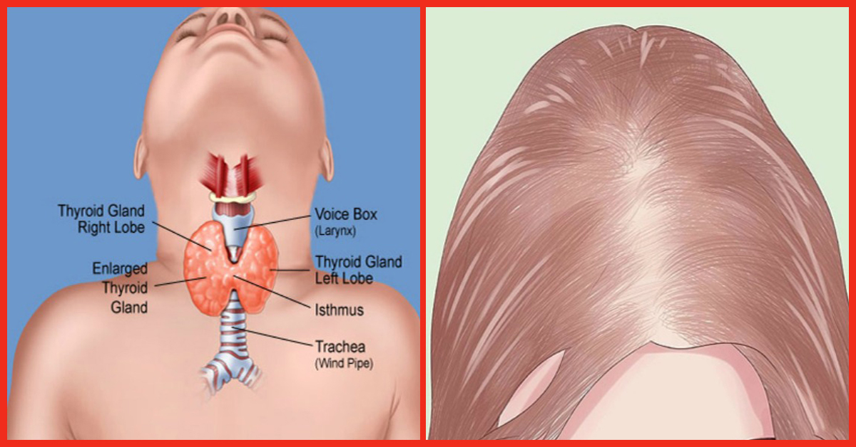 8 Simple Ways To Combat Thyroid Induced Hair Loss Naturally
