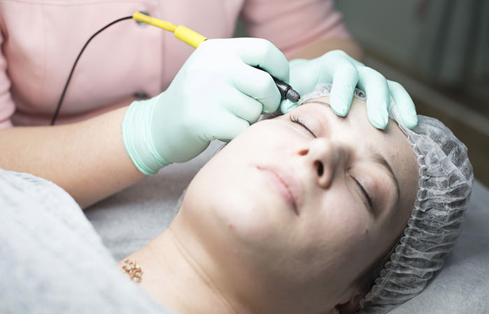 Electrolysis treatment to remove white facial hair