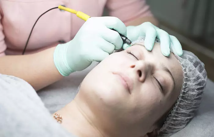Electrolysis treatment to remove white facial hair