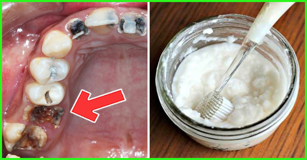 remove tartar from teeth