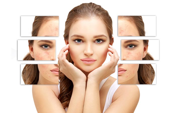 Galvanic facials prevent acne