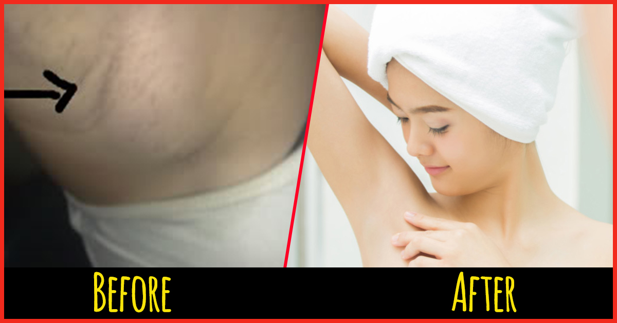 13 Home Remedies To Reduce Armpit Lumps