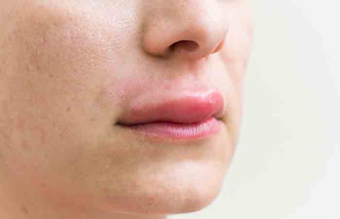 Closeup of allergic reactions on the lips as a side effect of stevia