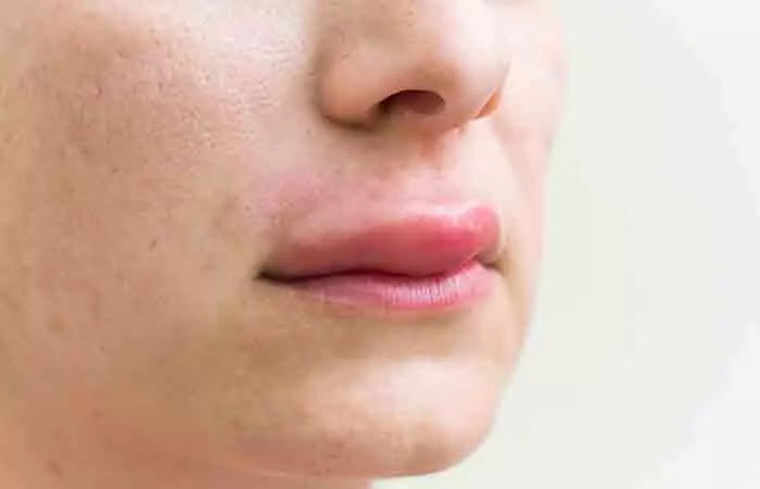 Closeup of allergic reactions on the lips as a side effect of stevia