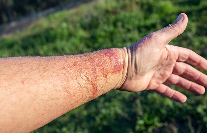 A hand showing photodermatitis