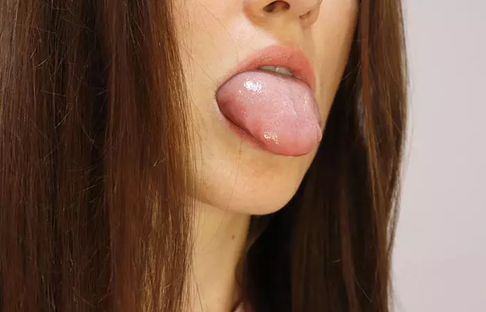Woman with oral allergy on tongue for pineapple