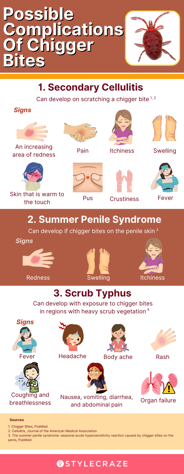 possible complications of chigger bites (infographic)