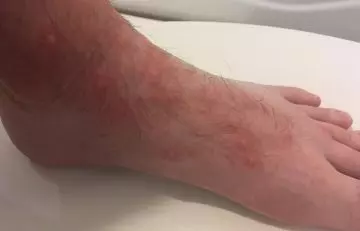 Close up shot of infected foot from chigger bites
