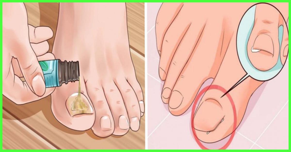 12 Home Remedies For Toenail Fungus Prevention Tips