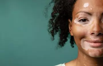 Vitiligo is one of the causes of poliosis