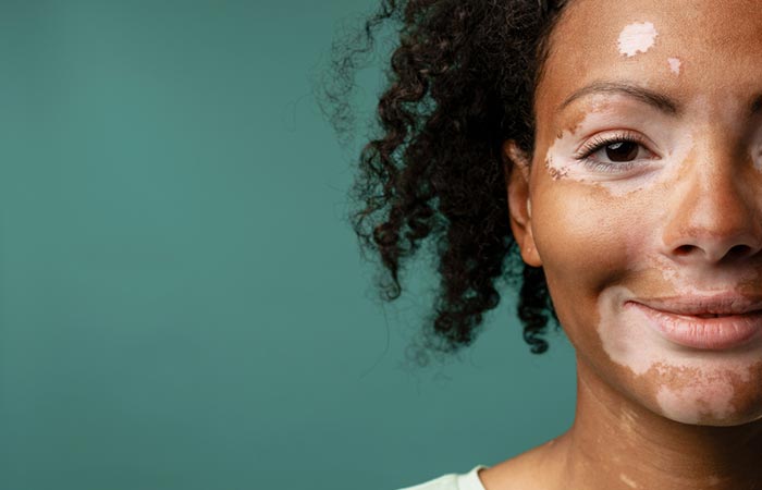 Vitiligo is one of the causes of poliosis