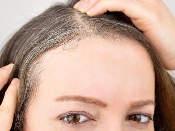 What Is Poliosis Causes And Treatment