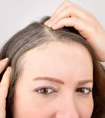 What Is Poliosis Causes And Treatment