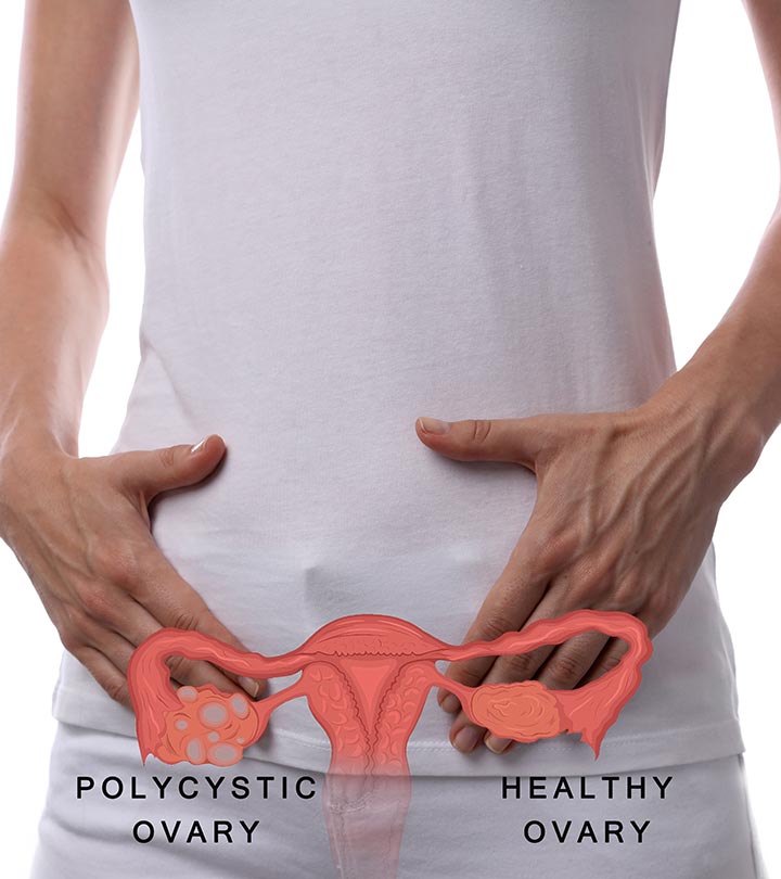 17 Home Remedies For Polycystic Ovary Syndrome (PCOS) + ...