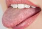 15 Effective Home Remedies For Oral T...