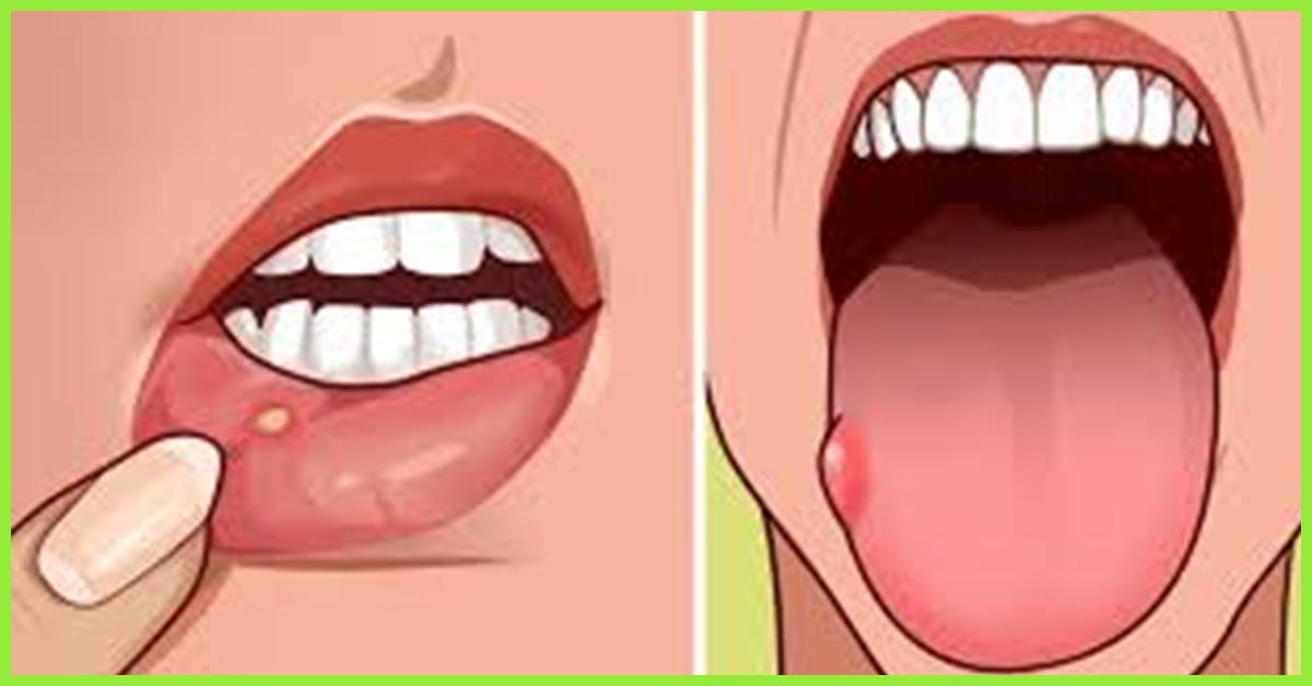 16-home-remedies-for-blisters-on-the-tongue-prevention-tips