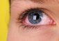 Welder's Flash Burn Or Arc Eye Natural Treatment – 10 Home ...