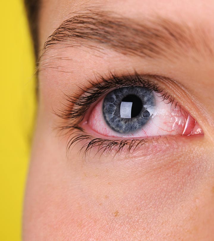 Welder’s Flash Burn Or Arc Eye Natural Treatment – 10 Home Remedies