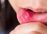 How To Use Honey To Heal Canker Sores?